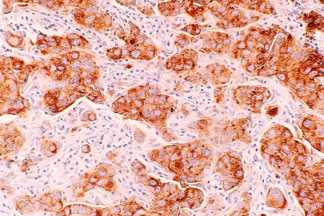 breast cancer cells (Ductal Carcinoma)